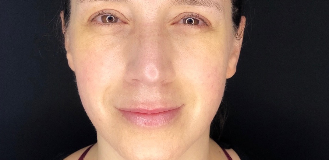 Resultat efter behandling med dermapen microneedling