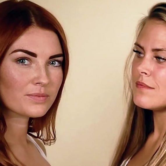 fillers nasolabialveck pris fillers nasolabialveck pris